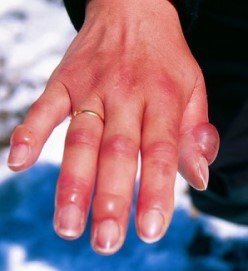 frostbite-hand-wikimedia